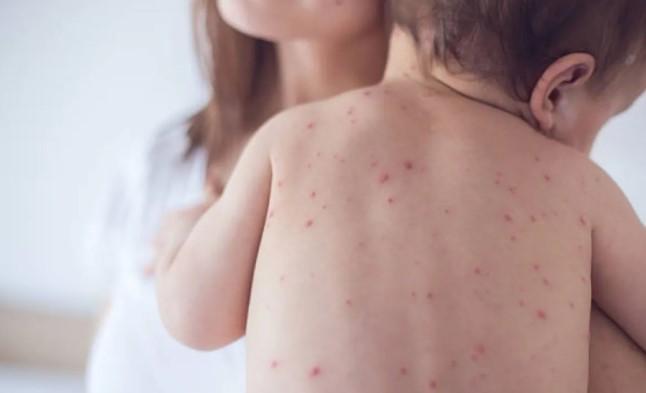 Dinkes DKI Jakarta Imbau Waspadai Penularan Campak saat Silaturahmi Idul Fitri