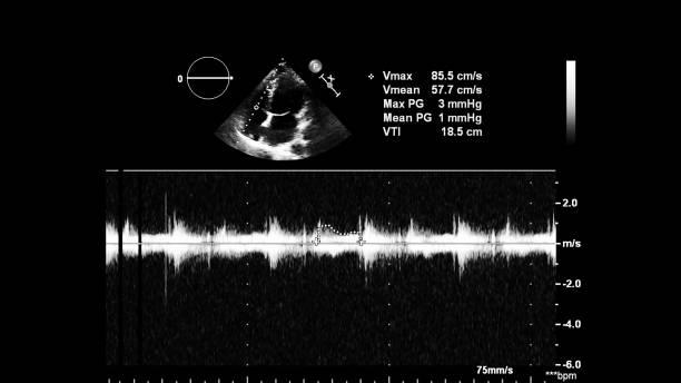 Deteksi Kanker Paru, Yuk Kenalan dengan Teknologi Endobronchial Ultrasound