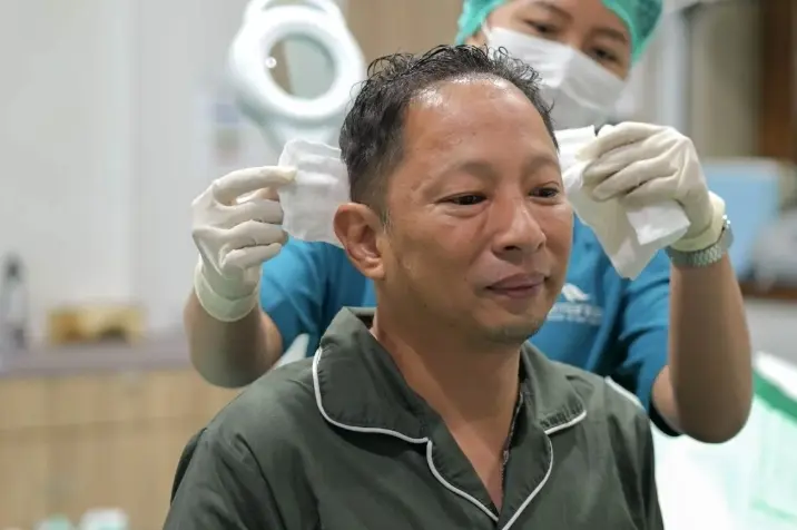 Dokter Ungkap Transplantasi Rambut Perlu Dilakukan Bertahap agar Area Donor Tetap Terjaga