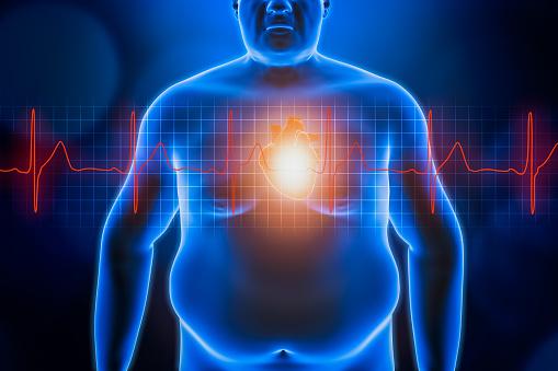 Pentingnya Jaga Nutrisi Seimbang untuk Obesitas Pengidap Kanker