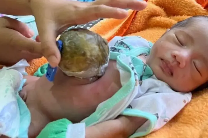 Bayi Penderita Kelainan Usus di Pandeglang Butuh Bantuan Donatur untuk Operasi