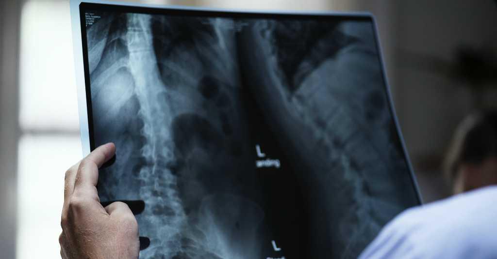 Kenali 4 Tanda Kekurangan Kalsium yang Bisa Sebabkan Kematian