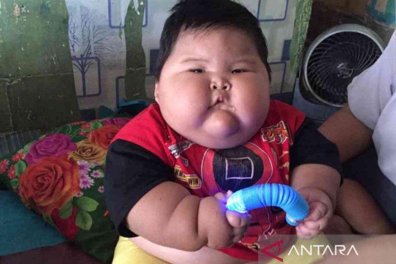 Menkes Siap Dampingi Perawatan Bayi Obesitas 27 Kilogram di Bekasi