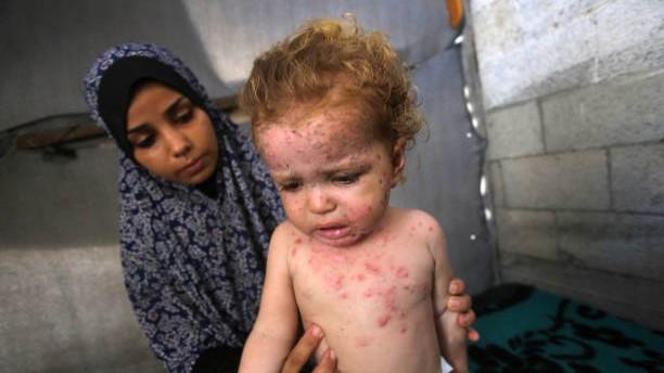 Pilu Anak-anak Palestina Derita Penyakit Kulit Menular
