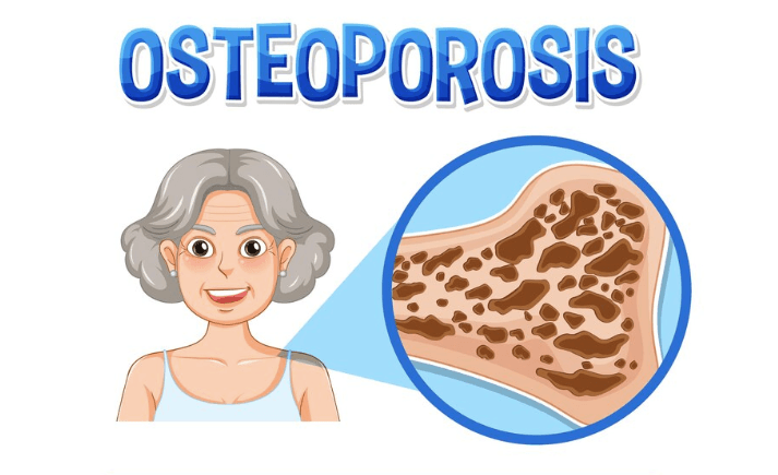 20 Oktober: Hari Osteoporosis Sedunia