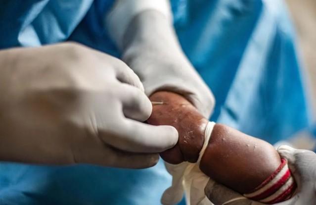 Lonjakan kasus mpox berlanjut, tiga negara sumbang lebih dari 90 persen kasus pekan ini