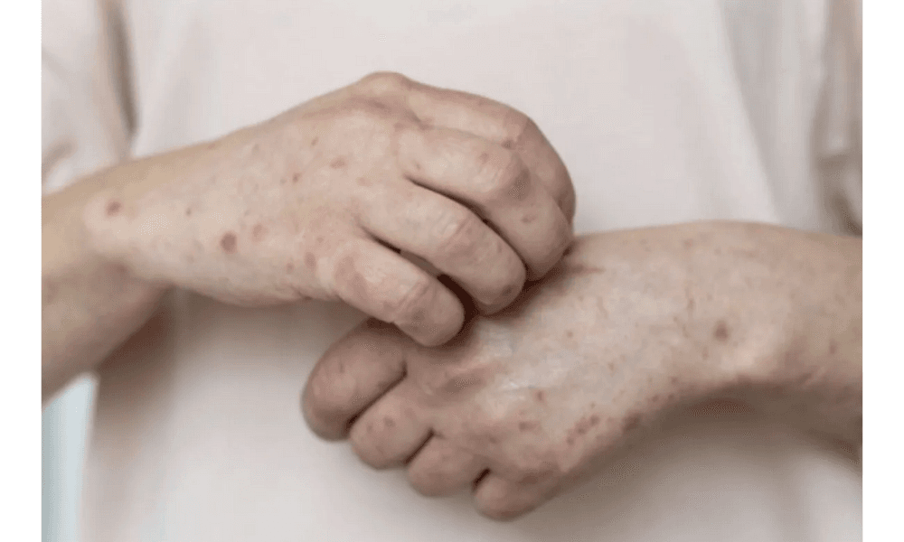 Kemenkes Terima Notifikasi Australia Soal Kasus Campak dengan Riwayat Perjalanan dari Indonesia