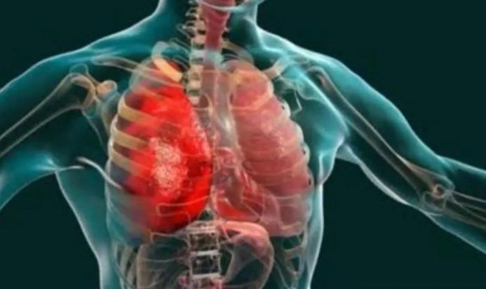 Dokter Ungkap Lima Kebiasaan Sehari-hari yang Dapat Membantu Mengurangi Peradangan Secara Alami