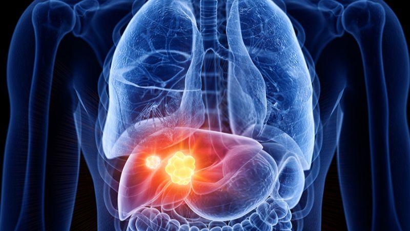Dokter: Waspadai Kanker Hati Jika Maag Tak Kunjung Sembuh