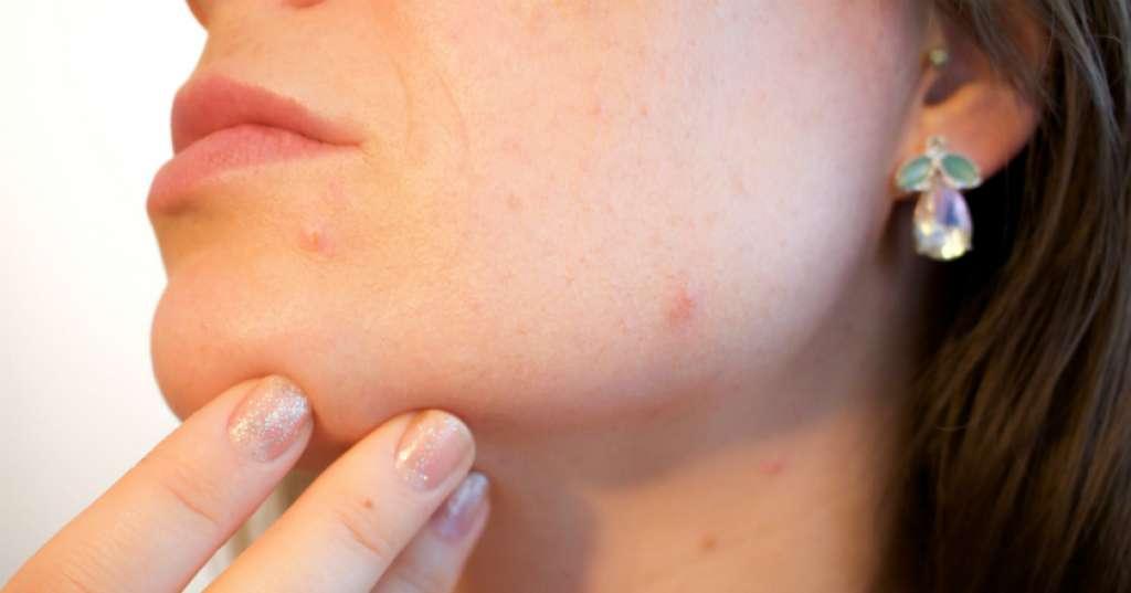 Jangan Abaikan Masalah pada Kulit, Bisa Tentukan Kondisi Kesehatan Loh