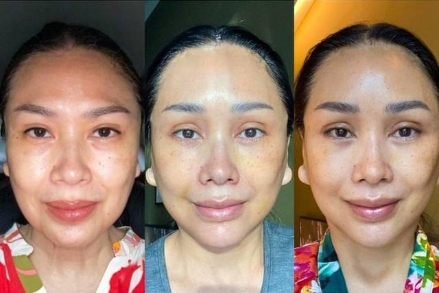 Titi DJ Jalani Lima Prosedur Operasi Plastik di Korea Selatan. Seperti Apa Prosesnya?